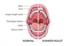 Menurut Penelitian, Minuman Bersoda Meningkatkan Risiko Kanker Mulut